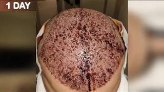 FUE Hair Transplant Timeline I Day 1 to Day 365 [upl. by Curson]