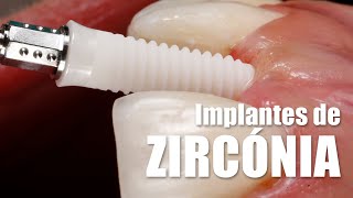 IMPLANTES DE ZIRCÓNIA  Vantagens  Dr Hugo Madeira [upl. by Calla737]