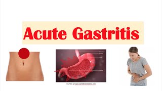 Acute Gastritis Stomach Inflammation  Causes Signs amp Symptoms Diagnosis Treatment [upl. by Cirdnek14]