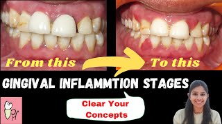 GINGIVITIS ‖ Stages Of Gingival Inflammation ‖ Perio Hub ‖ Dr Sneha [upl. by Aizatsana]