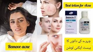 Best Acne Lotion  Dalacin T Lotion  Calindamycin 1 Acne Lotion Review [upl. by Viva]