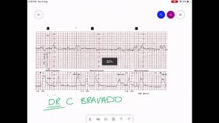 CARDIOTOCOGRAPHY  CTG INTERPRETATION [upl. by Enyt]