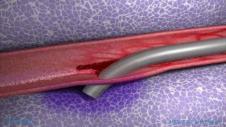 Peripheral IV Infiltration Animation [upl. by Hope]