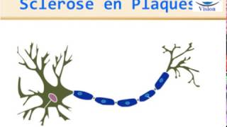 Sclérose en Plaques Physiopathologie Symptomes Diagnostic IRM traitement [upl. by Euqinot]