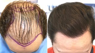 FUE Hair Transplant 4766 Grafts NW V By Dr Juan Couto  FUEXPERT CLINIC Madrid Spain [upl. by Clim296]