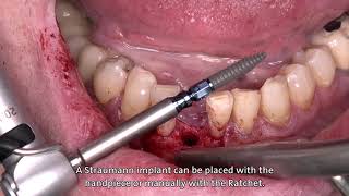 Dr Stefan P Hicklin Straumann® BLT Ø 29 mm implant [upl. by Luapnhoj]