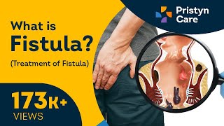 What is Fistula  Symptoms amp Treatment of Fistula [upl. by Yeuh]