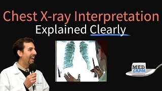 Chest XRay Interpretation Explained Clearly  How to read a CXR [upl. by Eibber60]