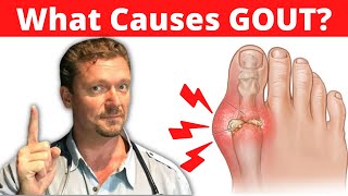 Gout Visual Explanation for Students [upl. by Rucker]