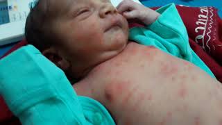 Erythema toxicum  Red rashes Skin rash Newborn skin rashes [upl. by Anits]