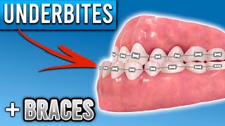 How Do Braces Fix Underbites  Premier Orthodontics [upl. by Odnalref]