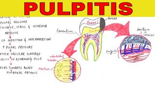 Pulpitis  Pathophysiology Causes amp Types [upl. by Gnouv]