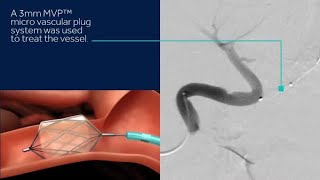 Medtronic Advisa™ DR MRI SureScan™ Pacemaker Video [upl. by Peria]