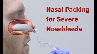 Nasal Packing for Severe Nosebleeds [upl. by Ahsiakal]