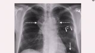 CXR in PE [upl. by Rratsal459]