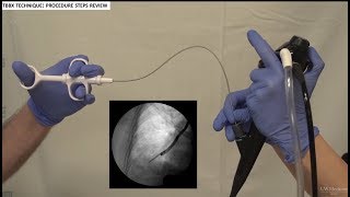 Transbronchial Biopsies  BAVLS [upl. by Ulund]