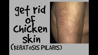 HOW TO GET RID OF CHICKEN SKIN KERATOSIS PILARIS DR DRAY [upl. by Nifled]