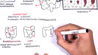 Colorectal Cancer  Overview [upl. by Annayat]