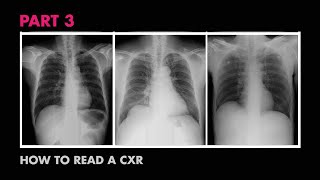 How XRays Work  How to Read a Chest XRay Part 3  MEDZCOOL [upl. by Sokil791]