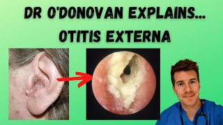 Explaining Otitis Externa  With Dr ODonovan [upl. by Haissi]