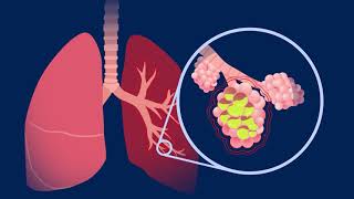 Understanding Pneumococcal Pneumonia [upl. by Rolph]