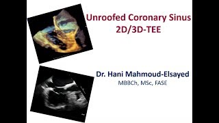 Unroofed Coronary Sinus  2D3D TEE CS defect [upl. by Iden986]