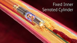 Mechanical Thrombectomy for Acute Stroke [upl. by Eibrik]