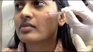 TCA Cross for Acne Scars DARK SKIN TONE Full Procedure Los Angeles CA [upl. by Rezeile449]