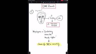 Case 4 Orbicularis Myokymia  Facial Nerve Overactivity [upl. by Mogerly]