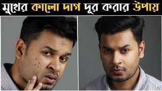 মুখের কালো দাগ সহজে দূর করার উপায় । How to Remove Dark Spots Naturally । কালো দাগ । ব্রনের দাগ [upl. by Hgierb852]