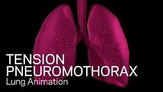 Tension Pneumothorax  Medical Animation [upl. by Akilaz]