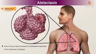 Atelectasis  Etiology Clinical Features Pathology pathophysiology Diagnosis and Treatment [upl. by Llenrap]