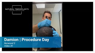 Shocking OneYear Hair Transplant Results Norwood 3 Patient  Dr Blumenthal [upl. by Alesandrini]