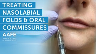 Using Dermal Fillers to Fill and Smooth Smile Lines  AAFE [upl. by Eerat]