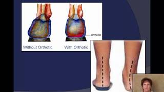 Plantar Fasciitis  How I Fixed My Plantar Fasciitis Problem With Dr Scholls Orthotics [upl. by Nabetse]