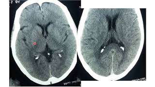 Basics of brain CT scan part II [upl. by Lux710]