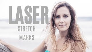 Howto Stretch Mark Removal With Laser Treatment [upl. by Kotta]