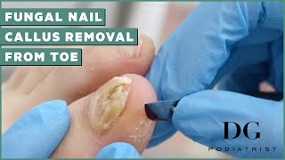 Fungal Nail Treatment And Callus Removal  The Foot Scraper DG Podiatrist [upl. by Stoffel]