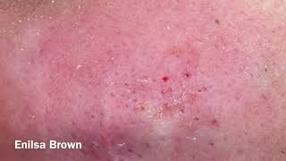 Blackheads Extractions Christian Part 2 [upl. by Jeroma]