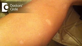 What causes sudden appearance of white round spots on legs  Dr Sudheendra Udbalker [upl. by Ayimat329]