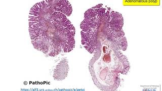 Colon Familial Adenomatous Polyposis [upl. by Eintruoc]