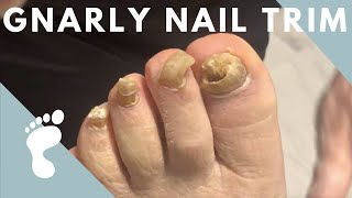 FUNGAL NAIL TRIM [upl. by Urba]