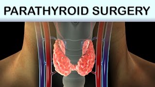 Parathyroid Surgery Medical Animation [upl. by Farnsworth]