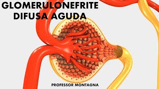 GLOMERULONEFRITE DIFUSA AGUDA [upl. by Cerelly503]