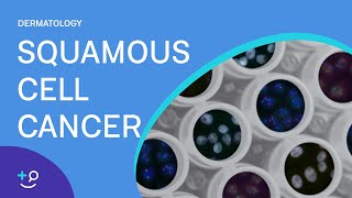 Squamous Cell Cancer Dermatology [upl. by Jehial604]