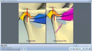 TMJ Disorders [upl. by Jorey]