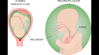 Meconium Aspiration Syndrome and HIE [upl. by Adlai]