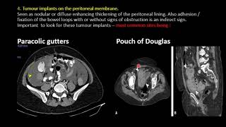 Peritoneal Dialysis PD Exit Site Dressing Procedure [upl. by Ongun]