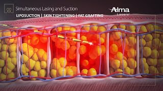 Liposuction Skin Tightening amp Fat Grafting  Lipo Life by Alma Lasers Medical Device 3D Animation [upl. by Gregorius]