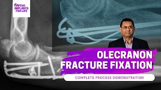 Olecranon Fracture Fixation  Procedure Demonstration [upl. by Bibbye]